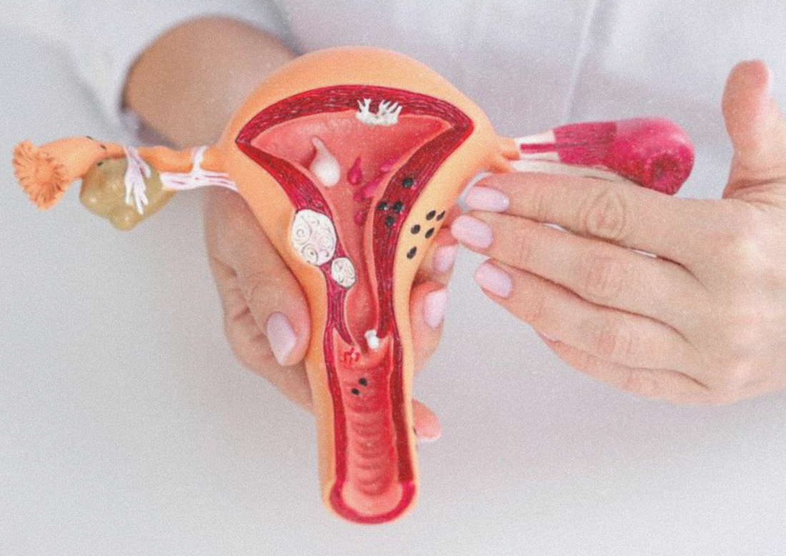 Endometriosis y nutrición: cómo la alimentación actúa sobre la inflamación y el dolor