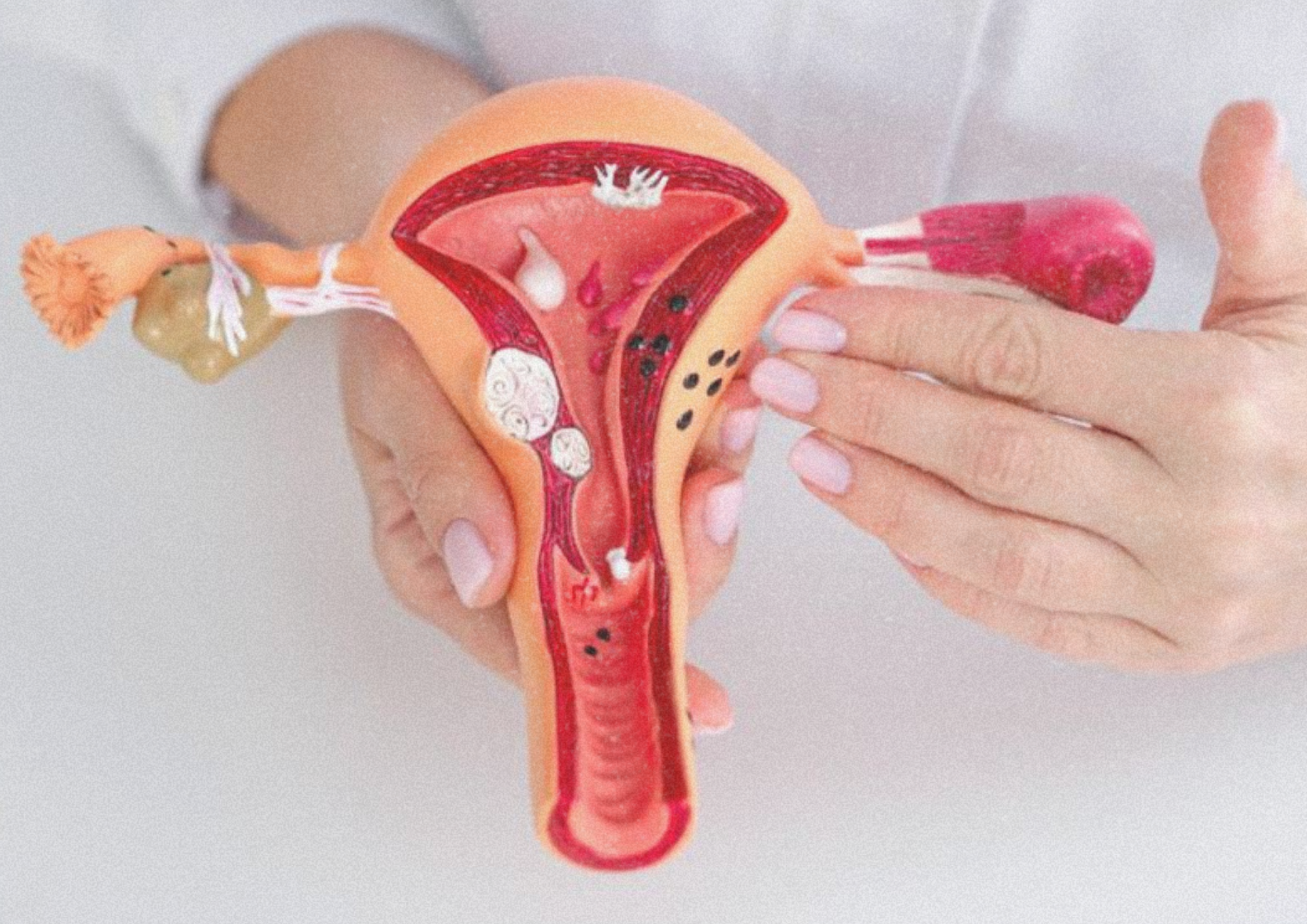 Endometriosis y nutrición: cómo la alimentación actúa sobre la inflamación y el dolor